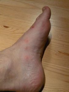 Foot covered in bite marks